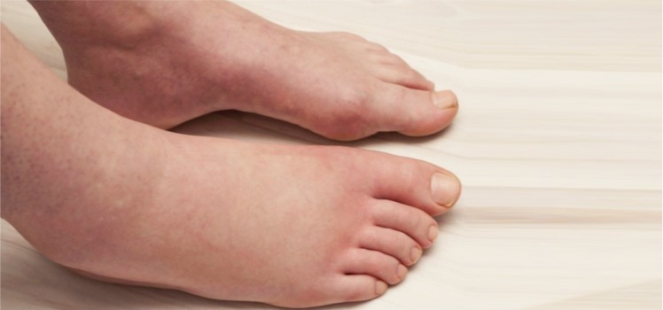 Home-Remedies-to-Get-Rid-of-Swollen-Feet-BLOG
